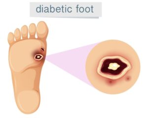 Diabetic foot problems