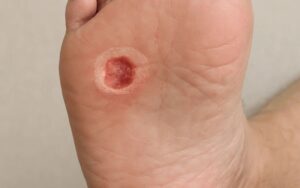 diabetic foot ulcer
