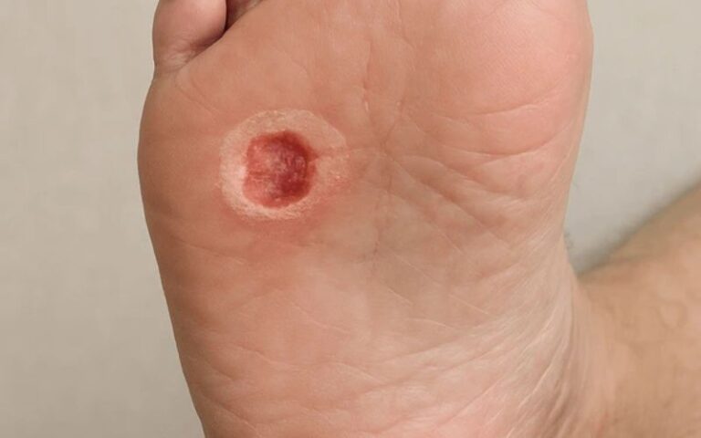 diabetic foot ulcer