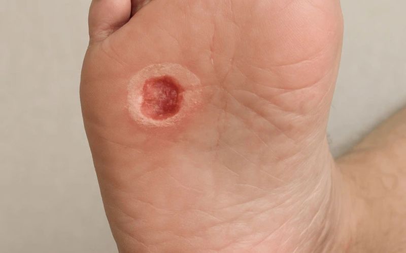 diabetic foot ulcer