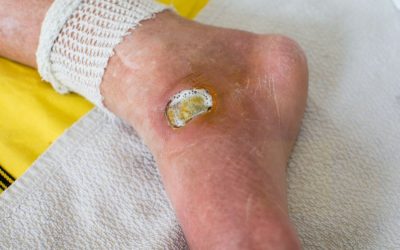 Diabetic Wound Care